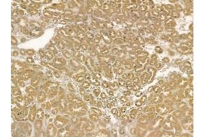 LASP1 Mouse Monoclonal Antibody at 1/100 staining human renal cell carcinoma by IHC-P.