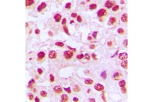 Immunohistochemical analysis of c-Rel staining in human breast cancer formalin fixed paraffin embedded tissue section. (c-Rel Antikörper  (C-Term))