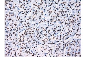 Immunohistochemical staining of paraffin-embedded Adenocarcinoma of colon tissue using anti-TYRO3mouse monoclonal antibody. (TYRO3 Antikörper)
