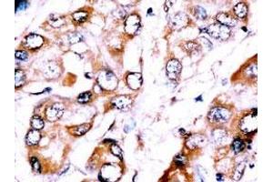 Formalin-fixed and paraffin-embedded human Hepatocellular carcinoma reacted with anti-HDBP2(HDRF-2) Antibody (Center), which was peroxidase-conjugated to the secondary antibody, followed by DAB staining. (ZNF395 Antikörper  (AA 141-170))