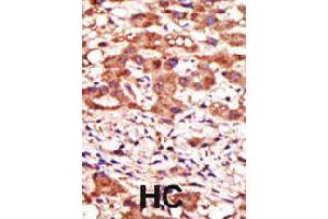Formalin-fixed and paraffin-embedded human hepatocellular carcinoma tissue reacted with MGAT1 polyclonal antibody  , which was peroxidase-conjugated to the secondary antibody, followed by AEC staining . (MGAT1 Antikörper  (N-Term))