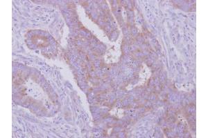 IHC-P Image Immunohistochemical analysis of paraffin-embedded human colon carcinoma, using HGS, antibody at 1:500 dilution. (HGS Antikörper  (C-Term))