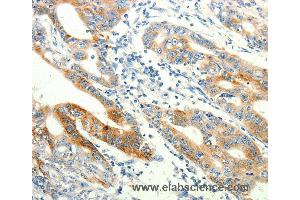 Immunohistochemistry of Human lung cancer using TRPA1 Polyclonal Antibody at dilution of 1:60 (TRPA1 Antikörper)