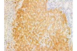 ABIN6262117 and ABIN6278010 at 1/100 staining human hepatocellular carcinoma by IHC-P. (GSTK1 Antikörper  (C-Term))