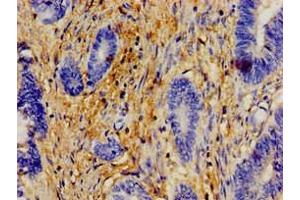 Immunohistochemistry of paraffin-embedded human colon cancer using ABIN7154609 at dilution of 1:100 (ERAL1 Antikörper  (AA 271-382))