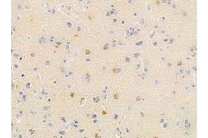 ABIN6266116 and ABIN6278648 at 1/100 staining human glioblastoma by IHC-P. (ZNF23 Antikörper  (Internal Region))