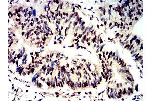 Immunohistochemical analysis of paraffin-embedded rectum cancer tissues using Phospho-4E-BP1 (Ser65) mouse mAb with DAB staining. (eIF4EBP1 Antikörper  (pSer65))