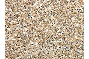 The image on the left is immunohistochemistry of paraffin-embedded Human prostate cancer tissue using ABIN7128049(TSC22D1 Antibody) at dilution 1/30, on the right is treated with fusion protein. (TSC22D1 Antikörper)