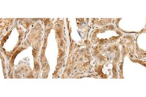 Immunohistochemistry of paraffin-embedded Human thyroid cancer tissue using ZUFSP Polyclonal Antibody at dilution of 1:35(x200) (ZUFSP Antikörper)