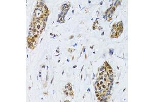 Immunohistochemistry of paraffin-embedded human breast cancer using CIRBP antibody (ABIN5973938) at dilution of 1/100 (40x lens). (CIRBP Antikörper)