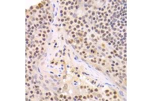 Immunohistochemistry of paraffin-embedded human amygdalitis using HMGB1 Antibody. (HMGB1 Antikörper  (AA 100-200))