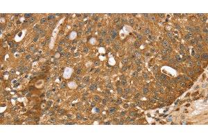 Immunohistochemistry of paraffin-embedded Human breast cancer using STARD5 Polyclonal Antibody at dilution of 1:40 (STARD5 Antikörper)