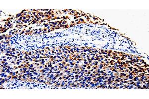 Immunohistochemistry of paraffin-embedded Human renal cancer tissue using COX10 Polyclonal Antibody at dilution 1:100 (COX10 Antikörper)