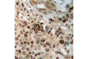 Immunohistochemical analysis of JAK2 staining in human breast cancer formalin fixed paraffin embedded tissue section. (JAK2 Antikörper)