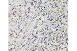 Immunohistochemistry of paraffin-embedded Human prostate cancer using SMARCC2 Polyclonal Antibody at dilution of 1:100 (40x lens). (SMARCC2 Antikörper)