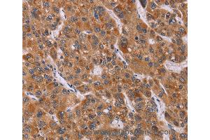 Immunohistochemistry of Human breast cancer using CALCA Polyclonal Antibody at dilution of 1:40 (CGRP Antikörper)