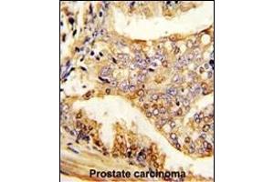 Formalin-fixed and paraffin-embedded human prostate carcinoma reacted with PUM2 Antibody , which was peroxidase-conjugated to the secondary antibody, followed by DAB staining.