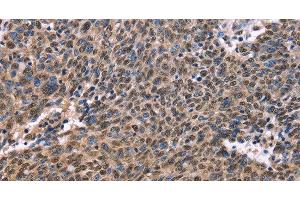 Immunohistochemistry of paraffin-embedded Human ovarian cancer using EVC2 Polyclonal Antibody at dilution of 1:40 (EVC2 Antikörper)