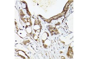 Immunohistochemistry of paraffin-embedded human colon carcinoma using UBQLN4 Rabbit pAb (ABIN7271124) at dilution of 1:150 (40x lens). (UBQLN4 Antikörper  (AA 300-390))