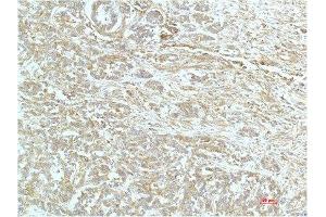 Immunohistochemical analysis of paraffin-embedded Human Breast Carrcinoma Tissue using a-actinin Mouse mAb diluted at 1:200. (ACTN1 Antikörper)