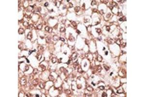 IHC analysis of FFPE human hepatocarcinoma tissue stained with the ABCB11 antibody (ABCB11 Antikörper  (AA 1038-1067))