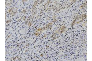 ABIN6272589 at 1/100 staining Human lung cancer tissue by IHC-P. (IL1F9 Antikörper  (N-Term))