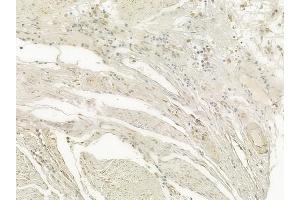 ABIN6256874 and ABIN6274505 at 1/100 staining human esophageal carcinoma by IHC-P. (XRN2 Antikörper  (N-Term))