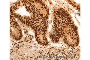 Immunohistochemistry of Human gastic cancer using E2F7 Polyclonal Antibody at dilution of 1:60 (E2F7 Antikörper)