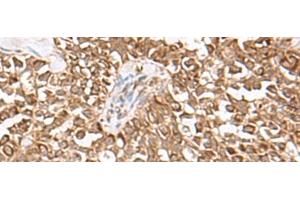 Immunohistochemistry of paraffin-embedded Human ovarian cancer tissue using USP16 Polyclonal Antibody at dilution of 1:25(x200) (USP16 Antikörper)