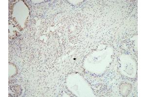 SNAI2 Antibody(ABIN6276471) staining human ovarian cancer tissue sections by IHC-f at 1:200. (SLUG Antikörper  (Internal Region))