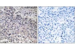 Immunohistochemistry analysis of paraffin-embedded human lung carcinoma tissue, using C1QC Antibody. (C1QC Antikörper  (AA 81-130))