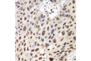 Immunohistochemistry of paraffin-embedded human lung cancer using GNB2L1 antibody (ABIN6292957) at dilution of 1:100 (40x lens). (GNB2L1 Antikörper)