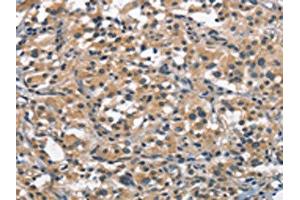 The image on the left is immunohistochemistry of paraffin-embedded Human thyroid cancer tissue using ABIN7189631(ACPT Antibody) at dilution 1/30, on the right is treated with synthetic peptide. (Testicular Acid Phosphatase (ACP4) Antikörper)