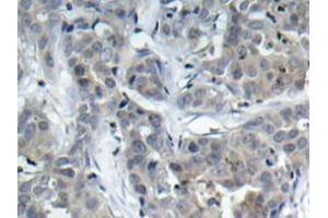Immunohistochemistry analyzes of Op18 antibody in paraffin-embedded human breast carcinoma tissue. (Stathmin 1 Antikörper)