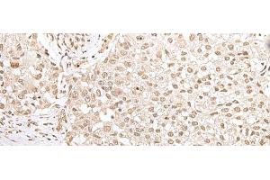 Immunohistochemistry of paraffin-embedded Human lung cancer tissue using ZKSCAN3 Polyclonal Antibody at dilution of 1:50(x200) (ZKSCAN3 Antikörper)