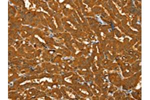 The image on the left is immunohistochemistry of paraffin-embedded Human thyroid cancer tissue using ABIN7130796(PYGM Antibody) at dilution 1/30, on the right is treated with fusion protein. (PYGM Antikörper)