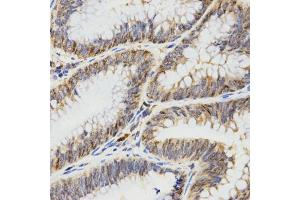 Immunohistochemistry of paraffin-embedded human rectal cancer using TPM2 antibody (ABIN5971583) at dilution of 1/200 (40x lens). (TPM2 Antikörper)