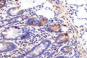 Immunohistochemistry analysis of paraffin-embedded human colon cancer using MIIP (ABIN7074626) at dilution of 1: 1200 (MIIP Antikörper)
