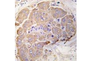 Formalin-fixed and paraffin-embedded human breast carcinoma tissue reacted with HSPB1 Antibody , which was peroxidase-conjugated to the secondary antibody, followed by DAB staining. (HSP27 Antikörper  (Ser82))