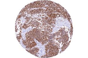 Rhabdomyosarcoma with strong TRIM72 staining of all tumor cells