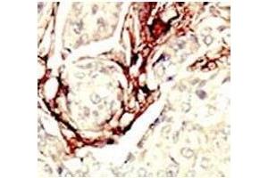 IHC analysis of FFPE human breast carcinoma tissue stained with the LKB1 antibody