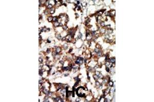 Formalin-fixed and paraffin-embedded human cancer tissue reacted with the primary antibody, which was peroxidase-conjugated to the secondary antibody, followed by DAB staining. (ATM Antikörper  (N-Term))