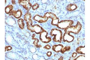 Formalin-fixed, paraffin-embedded human prostate carcinoma (20X) stained with AMACR / p504S Rabbit Monoclonal Antibody (13H4) (AMACR Antikörper)