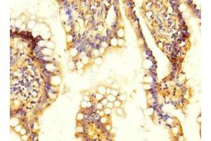 Immunohistochemistry of paraffin-embedded human colon cancer using ABIN7170096 at dilution of 1:100 (SLC13A2 Antikörper  (AA 345-455))