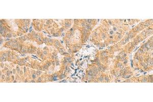 Immunohistochemistry of paraffin-embedded Human thyroid cancer tissue using NCOA4 Polyclonal Antibody at dilution of 1:130(x200) (NCOA4 Antikörper)