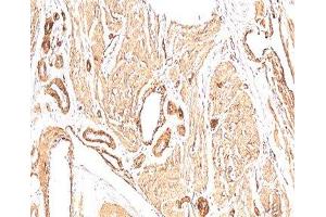 IHC: human leiomyosarcoma stained with Smooth muscle actin antibody (1A4). (Smooth Muscle Actin Antikörper  (N-Term))