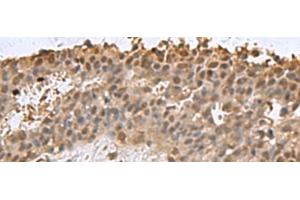 Immunohistochemistry of paraffin-embedded Human breast cancer tissue using DCTPP1 Polyclonal Antibody at dilution of 1:85(x200) (DCTPP1 Antikörper)