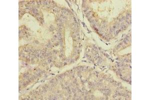 Immunohistochemistry of paraffin-embedded human endometrial cancer using ABIN7163315 at dilution of 1:100 (PLAA Antikörper  (AA 536-795))