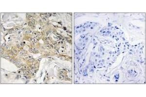 Immunohistochemistry analysis of paraffin-embedded human breast carcinoma tissue, using T4S1 Antibody. (TM4SF1 Antikörper  (AA 1-50))