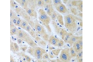 Immunohistochemistry of paraffin-embedded Human liver cancer using BLVRB Polyclonal Antibody at dilution of 1:100 (40x lens). (BLVRB Antikörper)